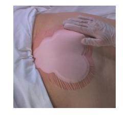 MEDICAZIONE IDROCELLULARE ADESIVA STERILE CONFORMATA PER LA REGIONE SACRALE ASSORBENTE IN SCHIUMA DI POLIURETANO ALLEVYN SACRUM 22,5X22,1CM 10PZ - Farmacia Artemisia di Montecuollo Dott. Angelo snc